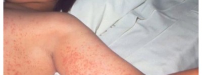 紧急通报：多伦多知名披萨店和VIA列车现麻疹暴露风险