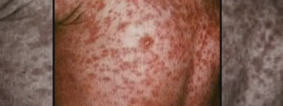 安省麻疹病例总数已超过1,000例：卫生局提醒这些人！