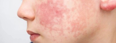 大多伦多地区多所学校爆发“第五病”病毒，这一人群需高度警惕