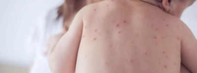 安省确认一名感染麻疹的婴儿死亡：出生前从母亲处感染