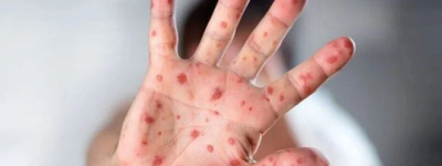 约克区卫生局确认麻疹病例，涉及皮尔逊机场及加航航班