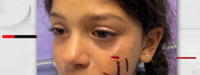 多伦多9岁女孩疑似在公园被无绳狗撕咬：脸上留下巨大伤口