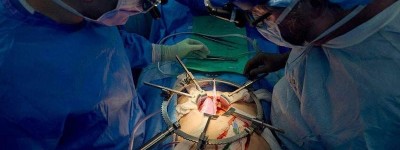 美国病患移植猪肾脏逾一个月 肾功能仍正常