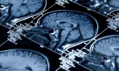 名校研究突破或可阻止癌細胞擴散至大腦